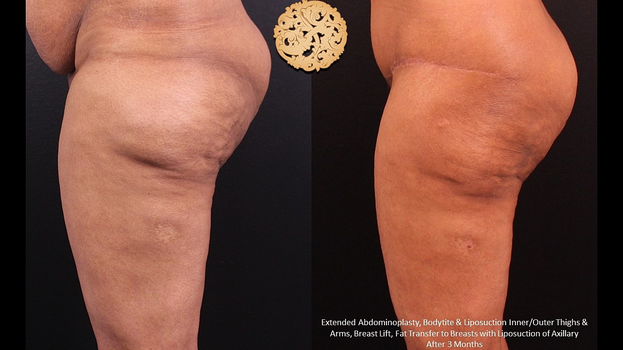 Before and after body contouring results.