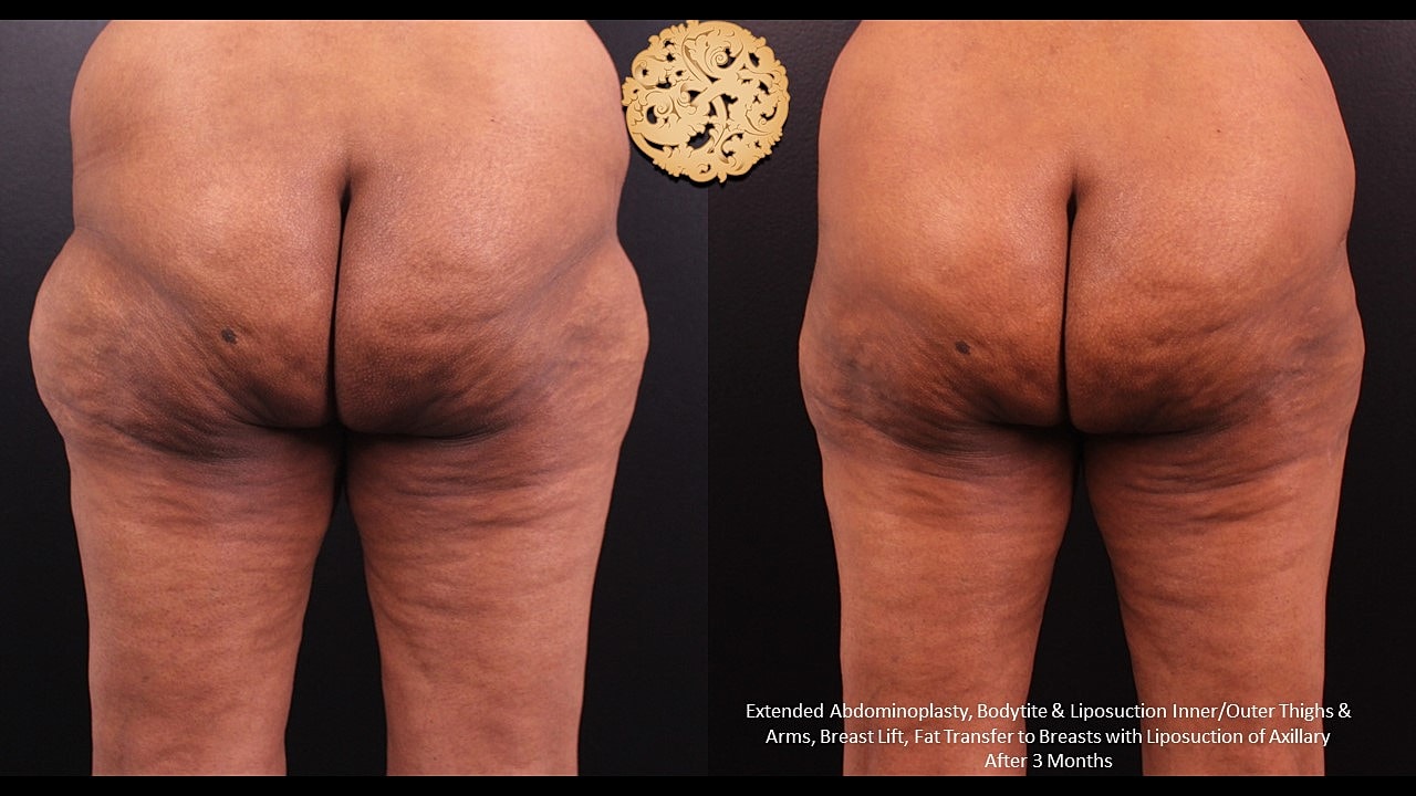 Post-surgery transformation, body contouring results.