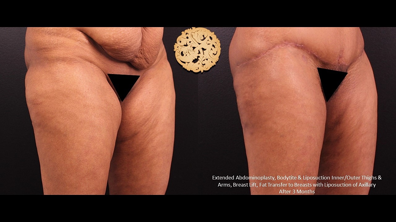 Post-surgery body contouring results after three months.