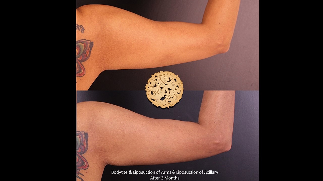 Arm contouring before and after treatment results.