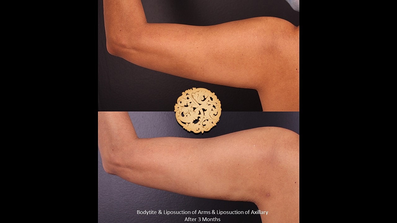 Post-liposuction comparison of arms after three months.