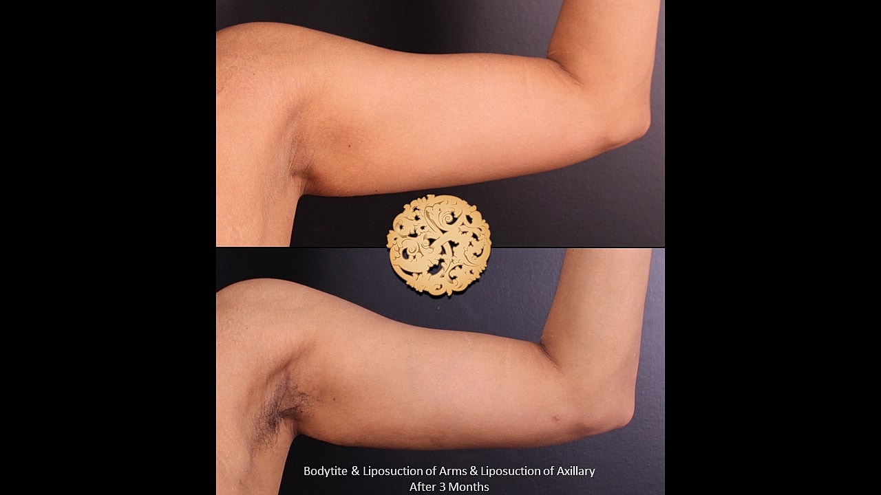 Liposuction results on arms after three months.