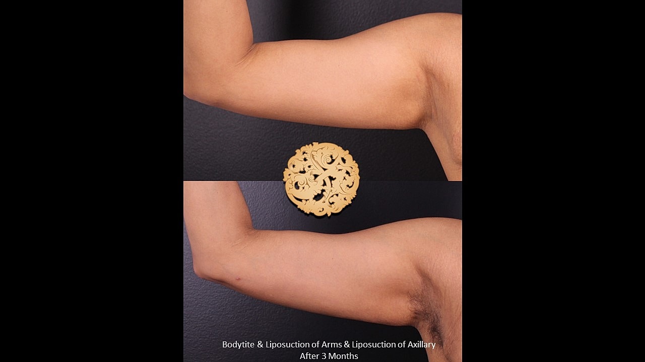 Liposuction results on arms and armpit area.