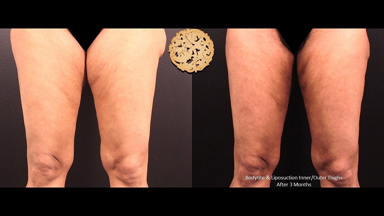 Thigh transformation after Bodytite and liposuction.