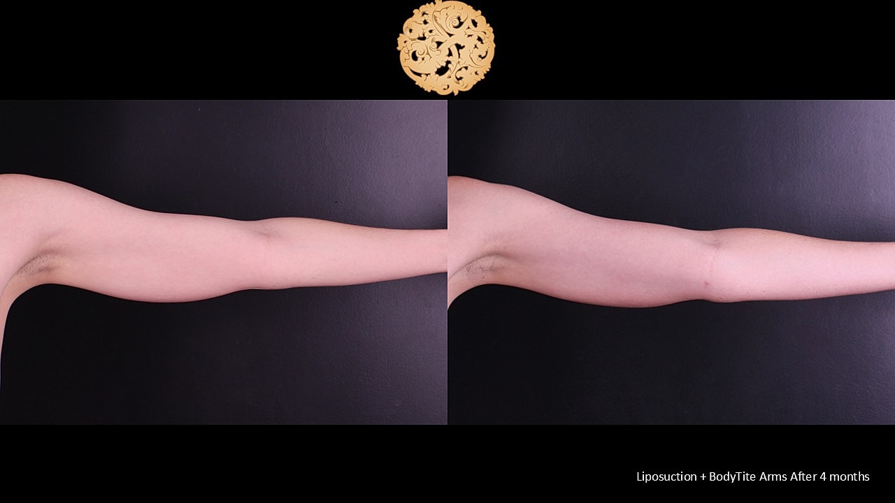 BodyTite Before & After