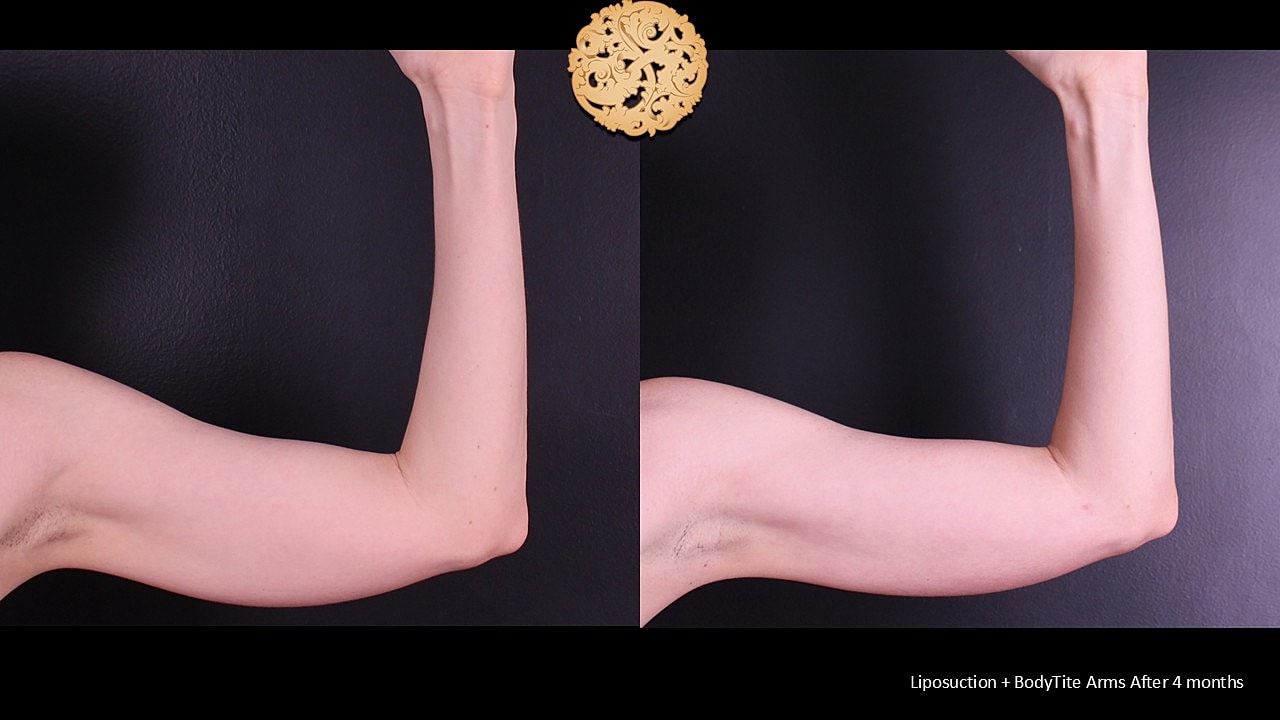 BodyTite Before & After