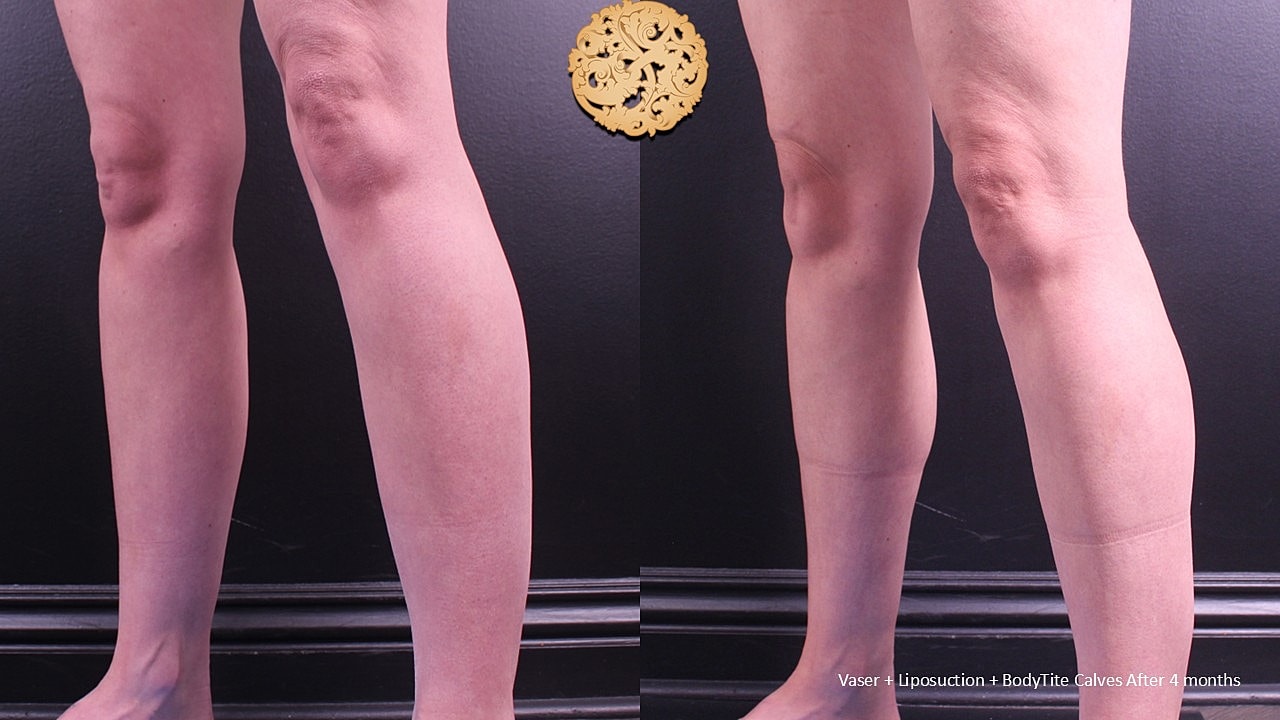 BodyTite Before & After