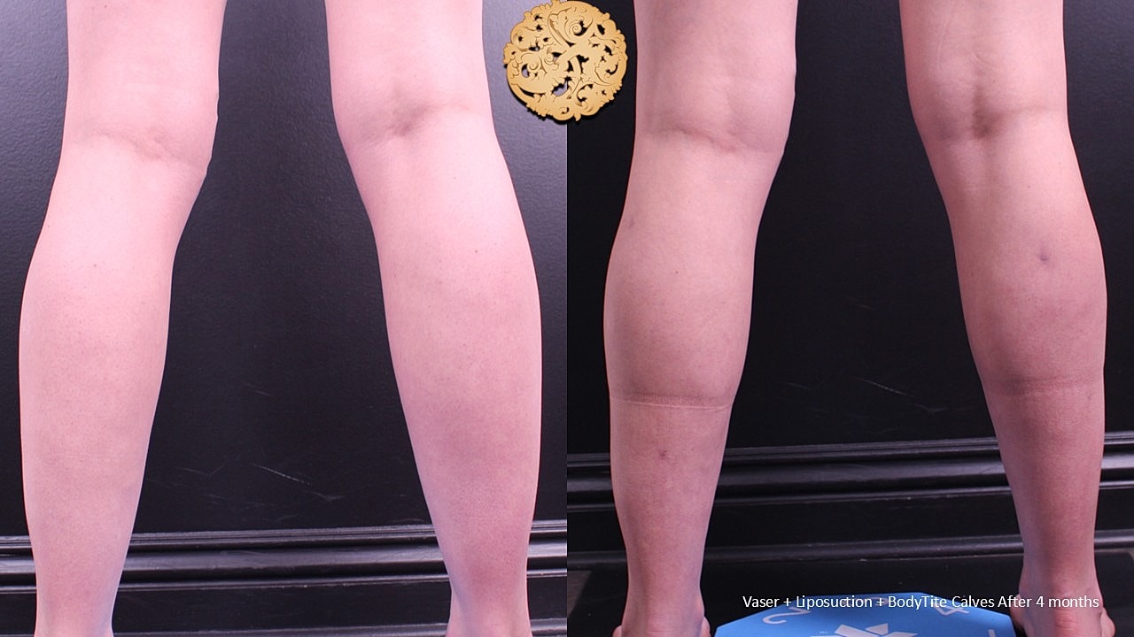 BodyTite Before & After