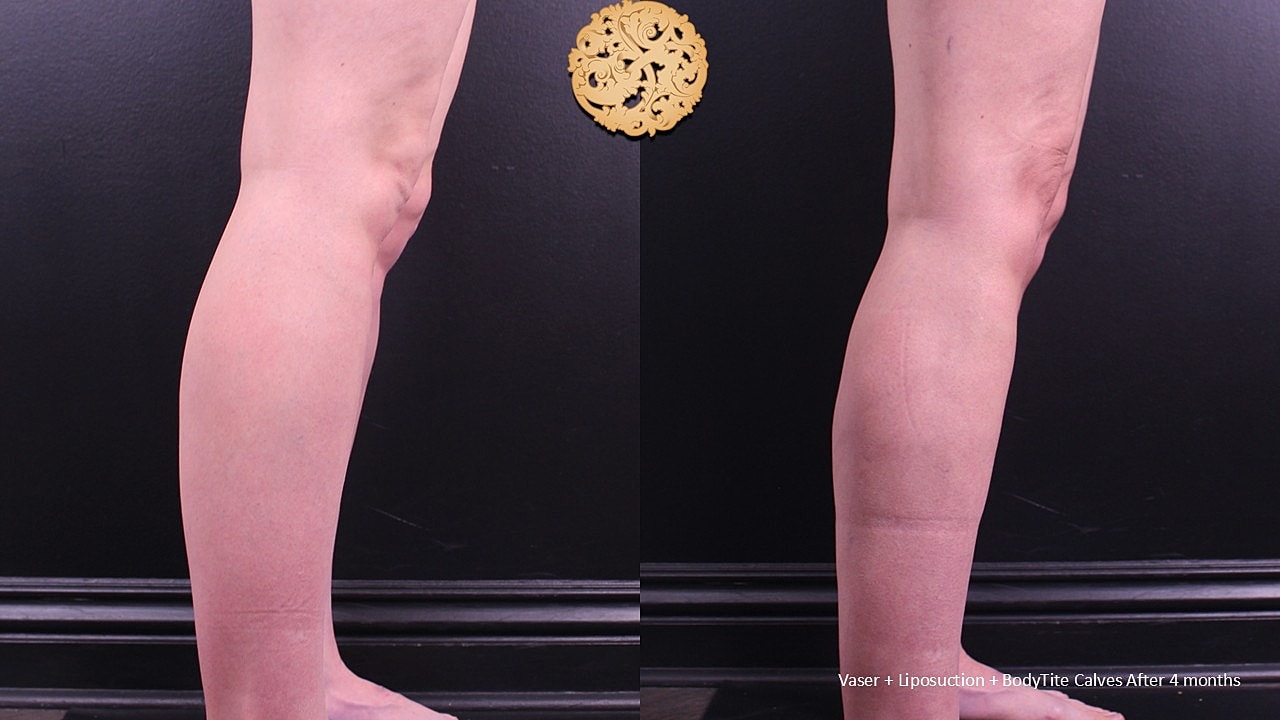 BodyTite Before & After