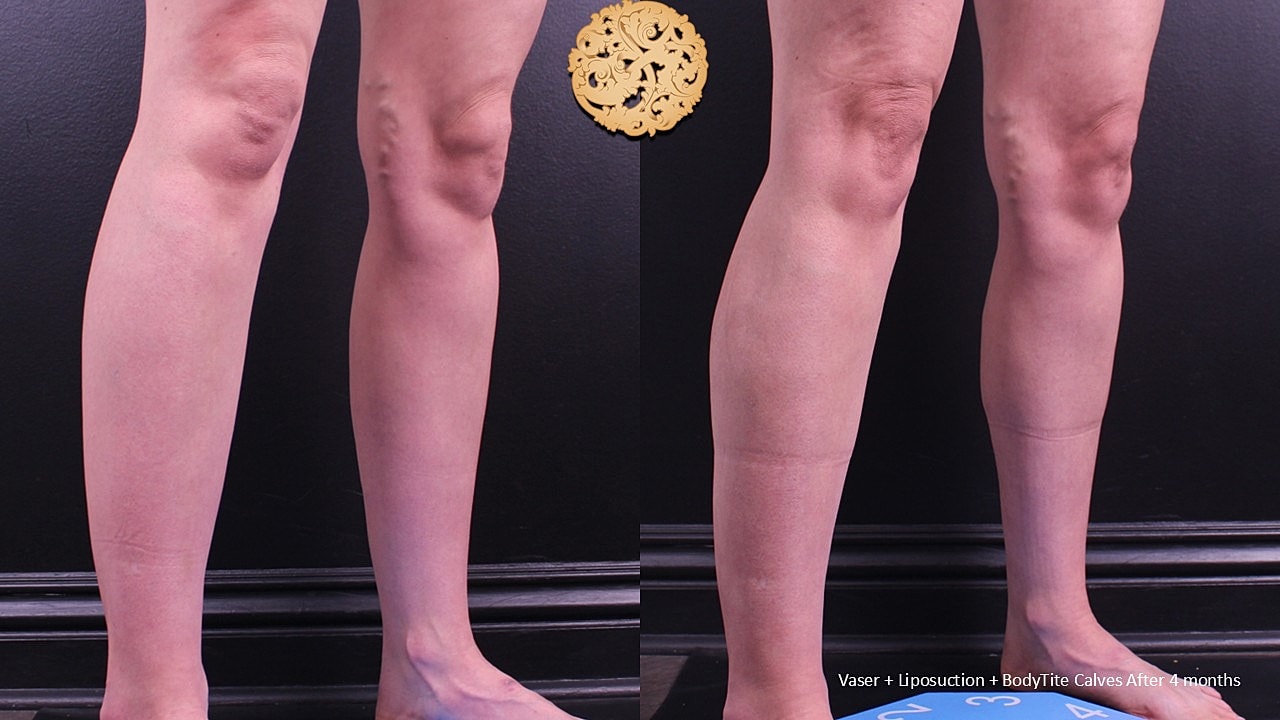 BodyTite Before & After