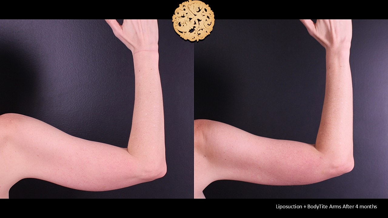 BodyTite Before & After