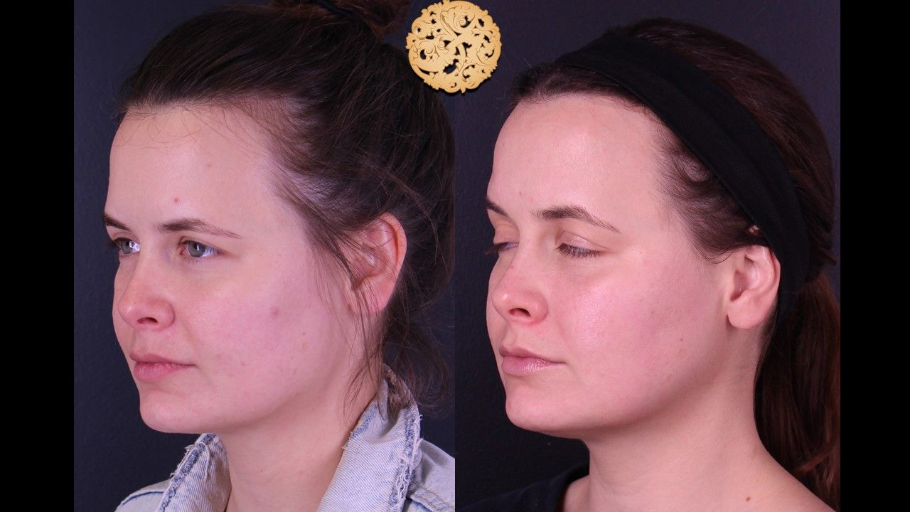 Gold Tip Facial Before & After