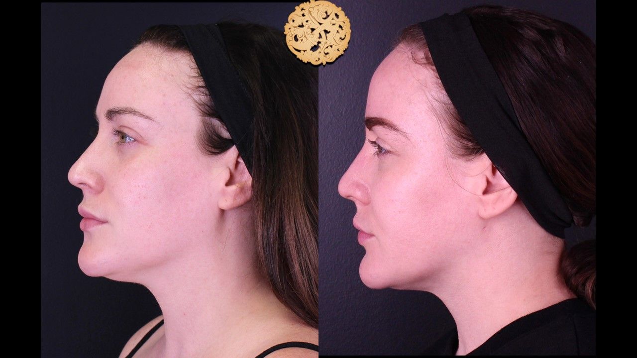 Gold Tip Facial Before & After