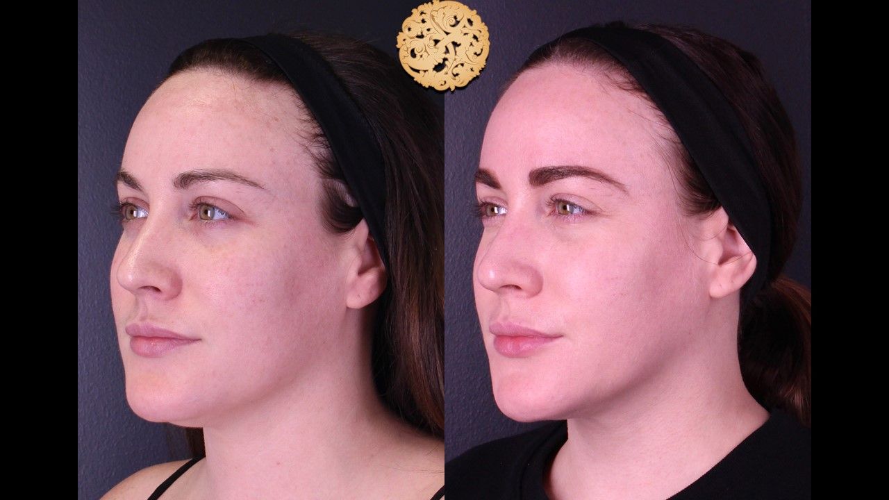 Gold Tip Facial Before & After