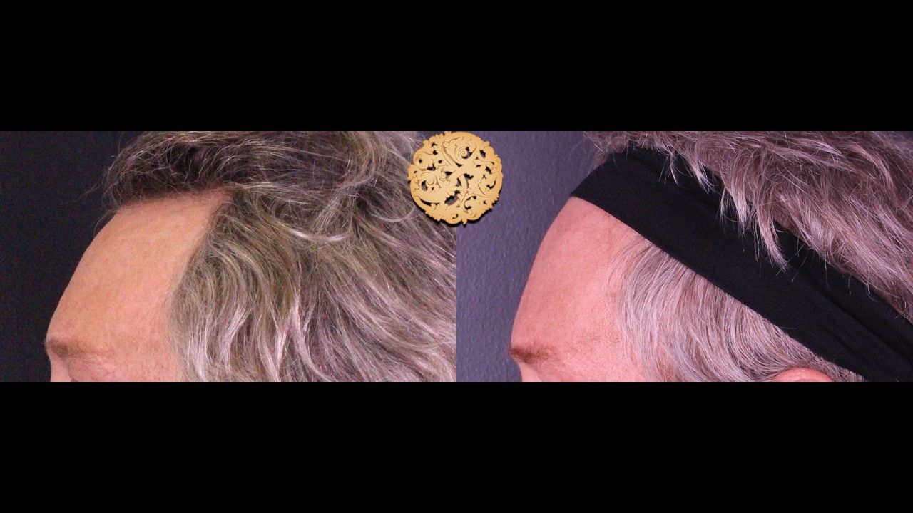 Facial Fat Transfer Forehead Before & After
