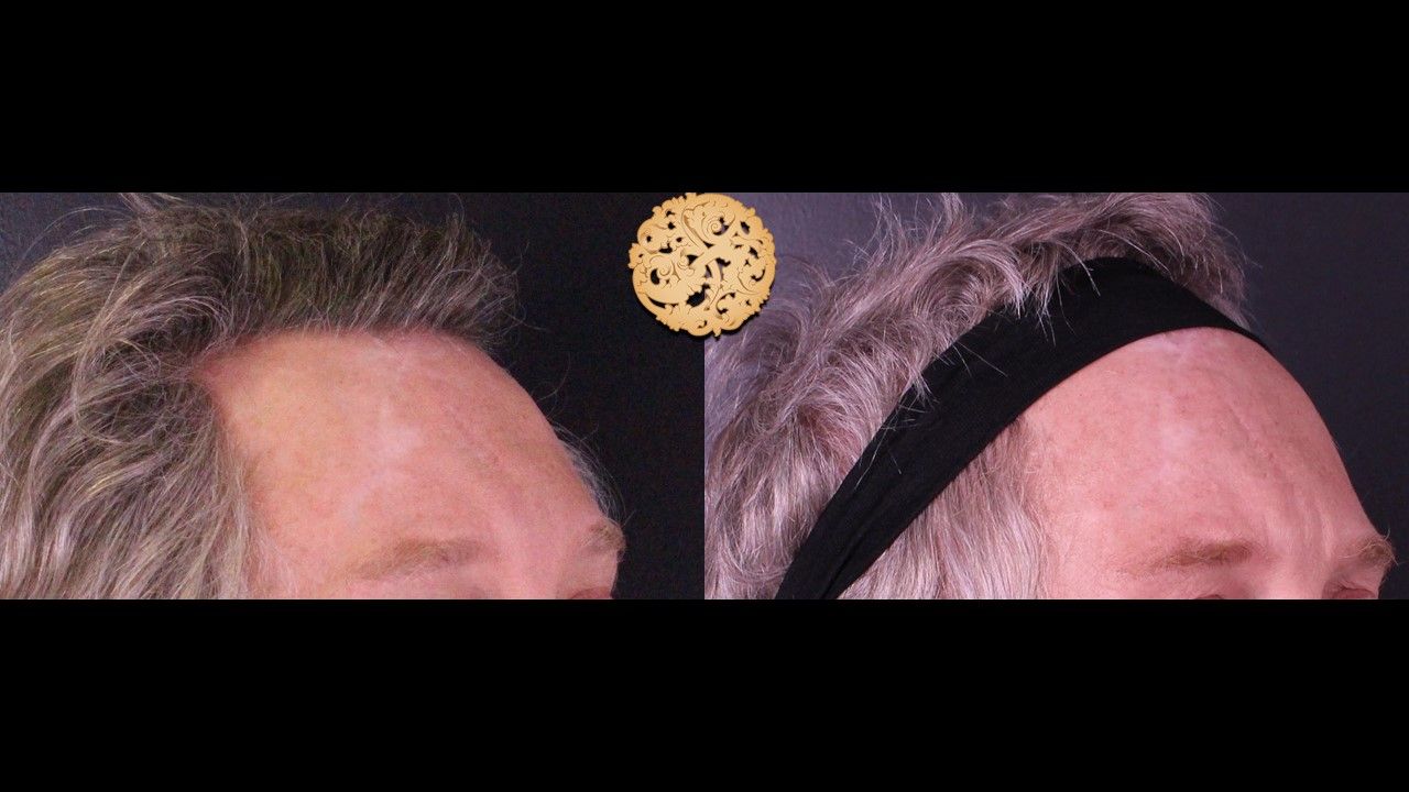 Facial Fat Transfer Forehead Before & After