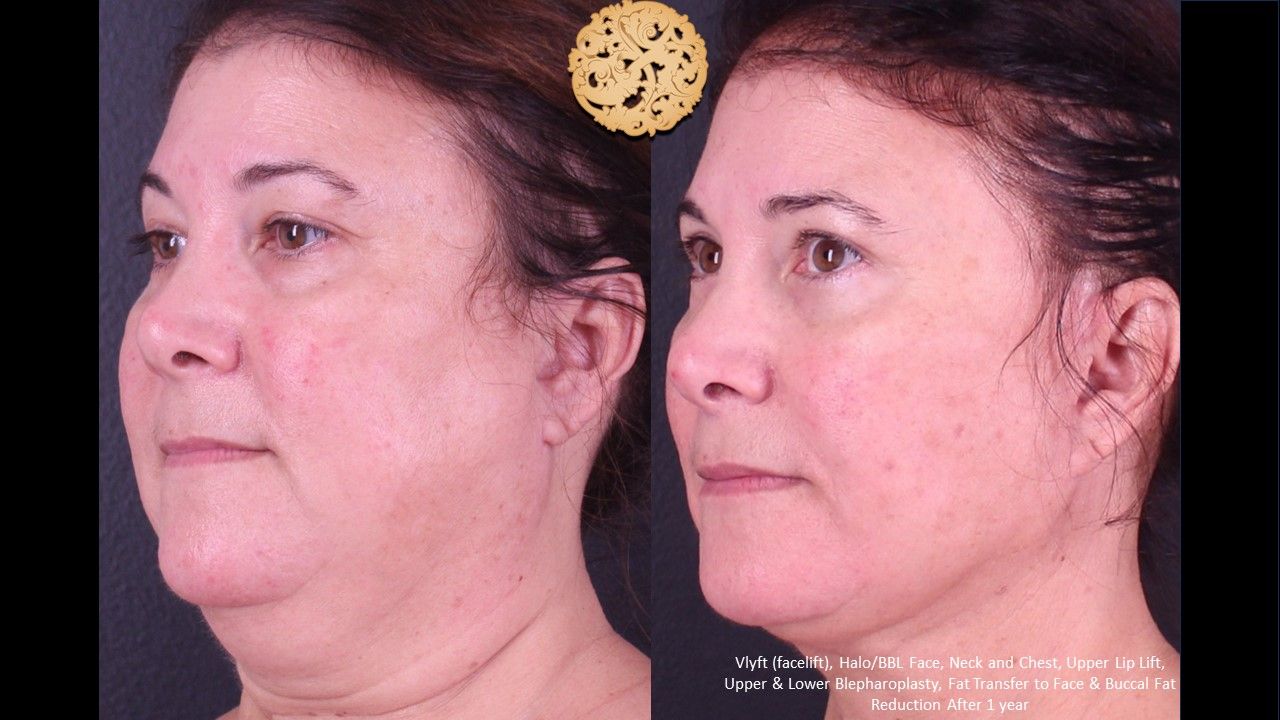 Facial Fat Transfer Forehead Before & After