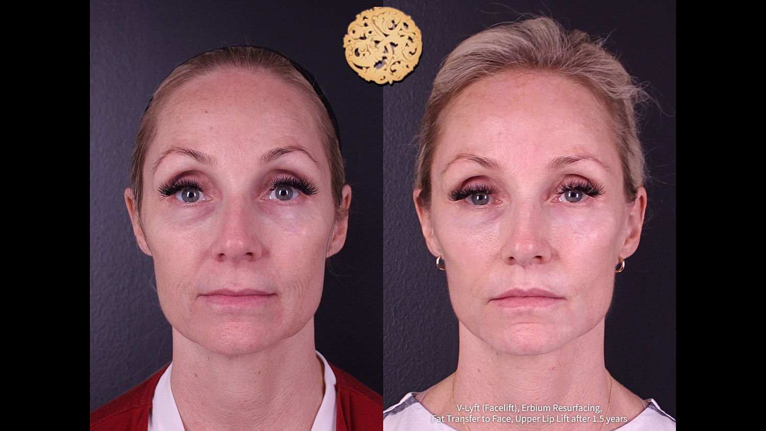 Before and after facial cosmetic procedures comparison.
