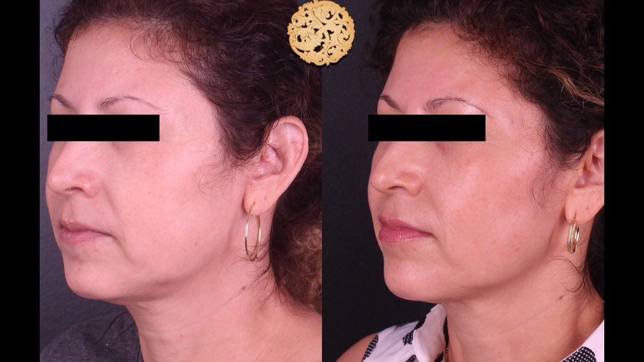 Genesis Before & After