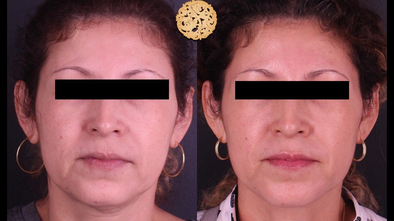 Genesis Before & After