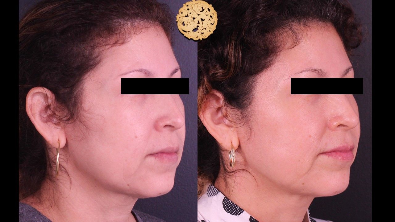 Genesis Before & After