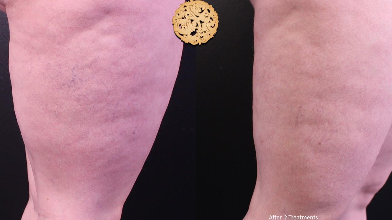 Genesis Before & After