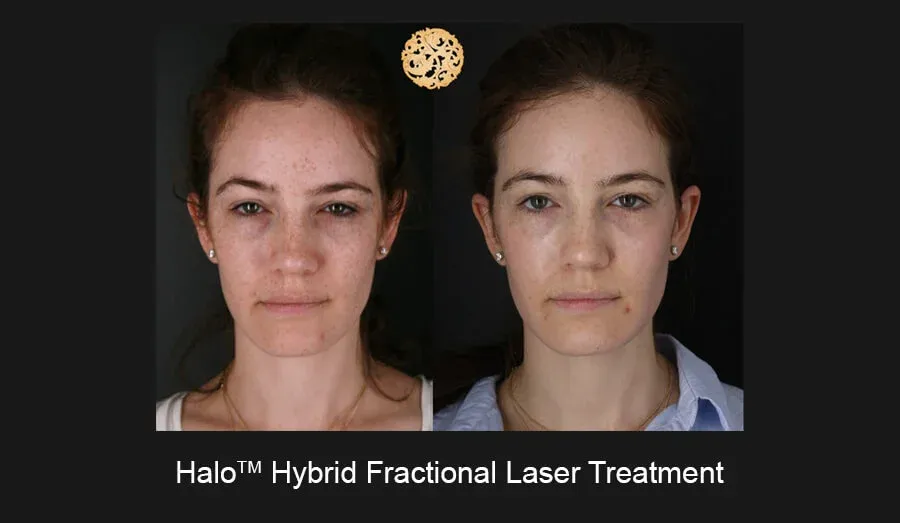 Halo Before & After