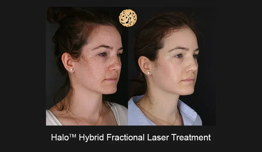 Halo Before & After