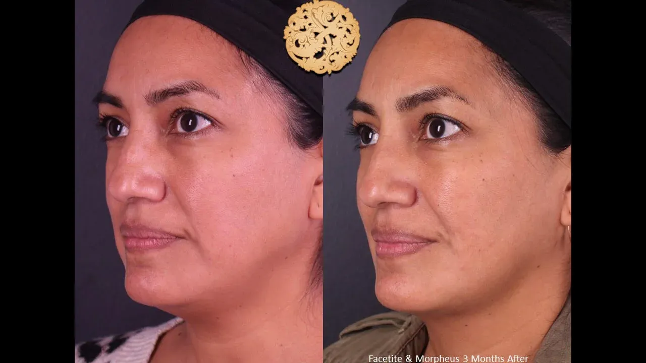 Morpheus8 Before & After