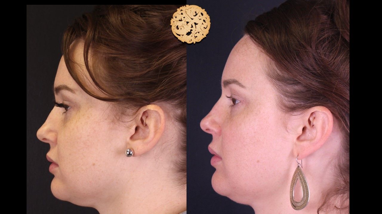 Dermal Infusion Before & After