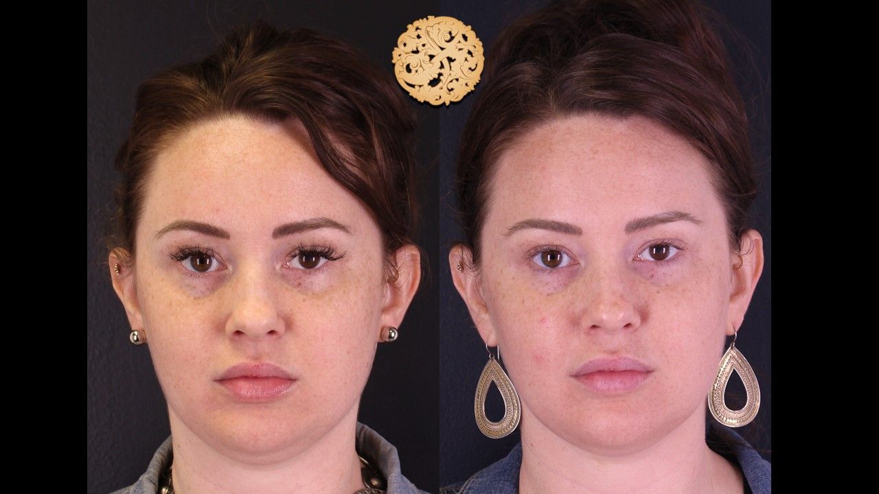 Dermal Infusion Before & After