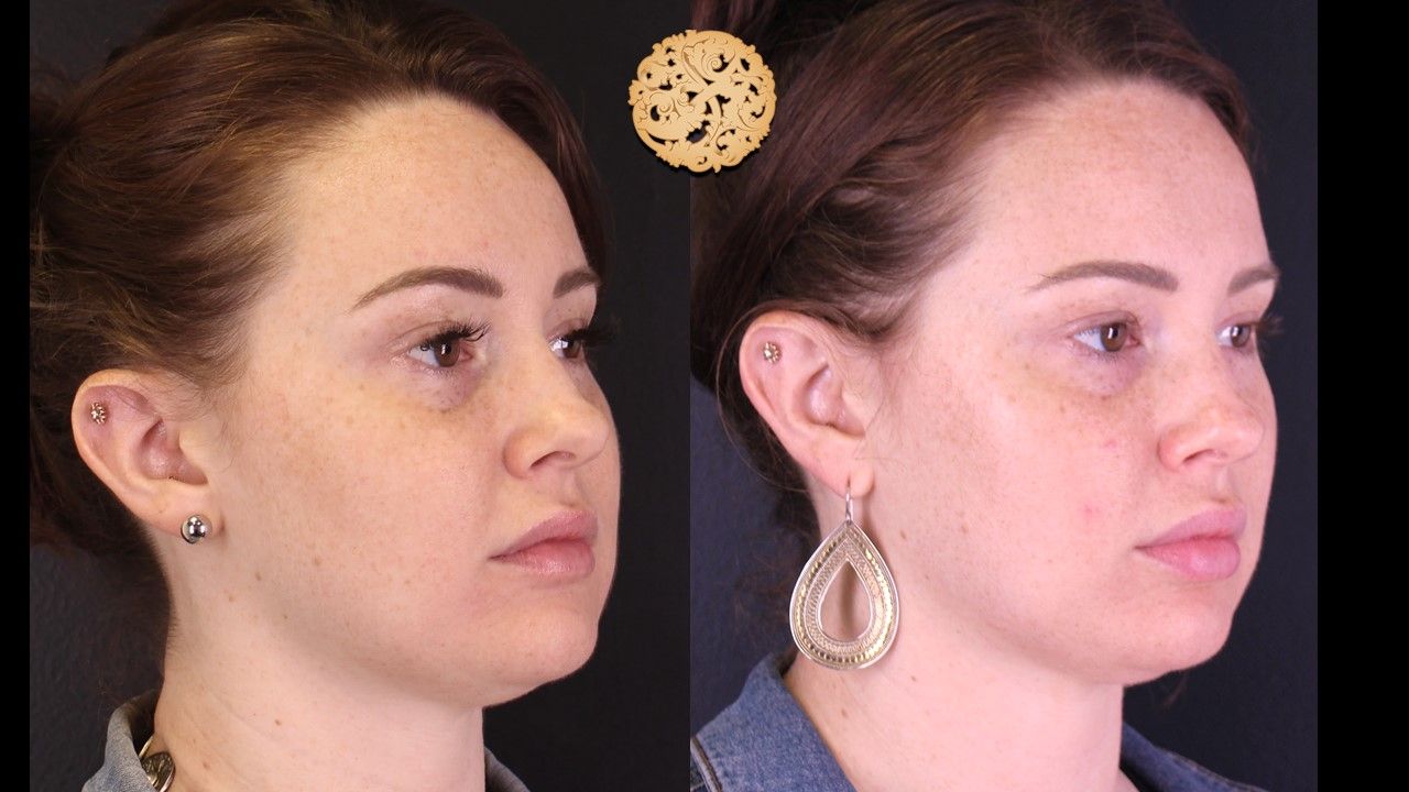 Dermal Infusion Before & After