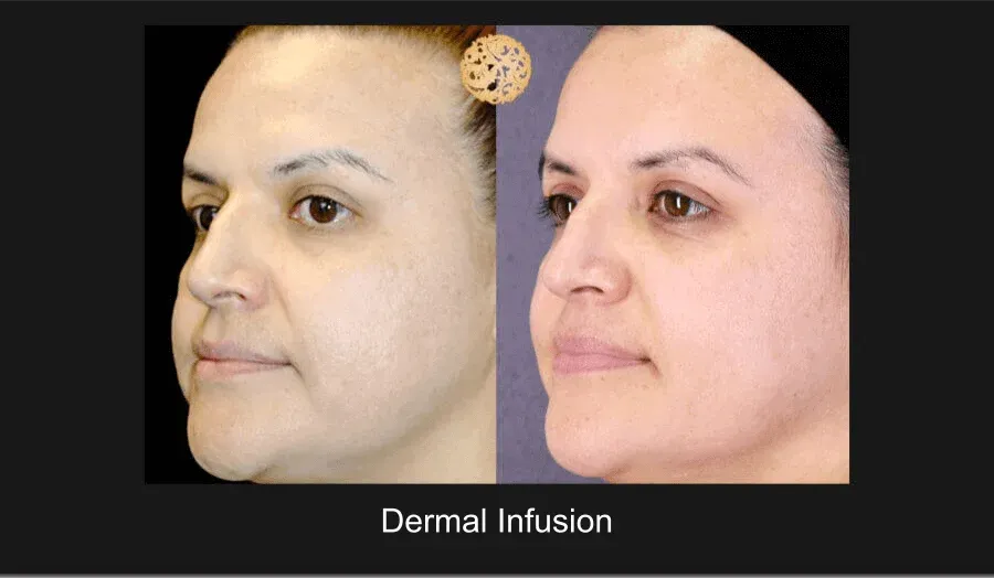 Dermal Infusion Before & After