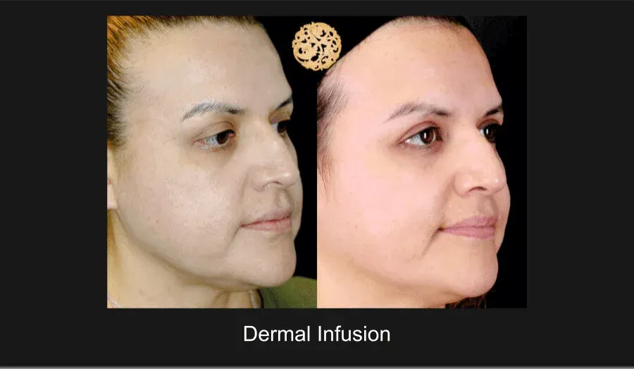 Dermal Infusion Before & After