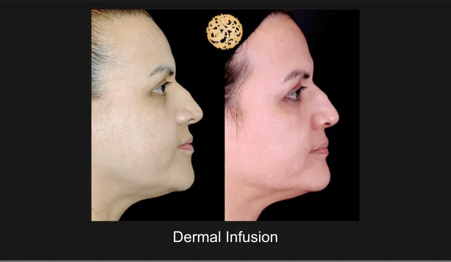 Dermal Infusion Before & After