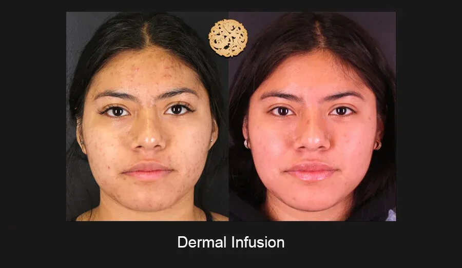Dermal Infusion Before & After