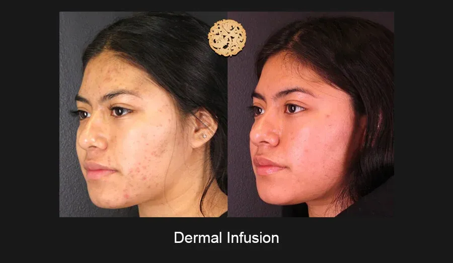 Dermal Infusion Before & After