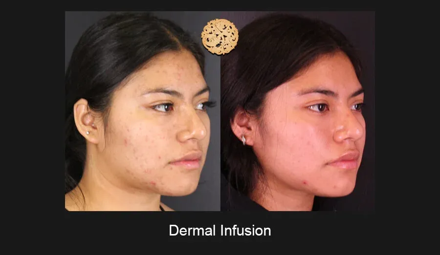 Dermal Infusion Before & After