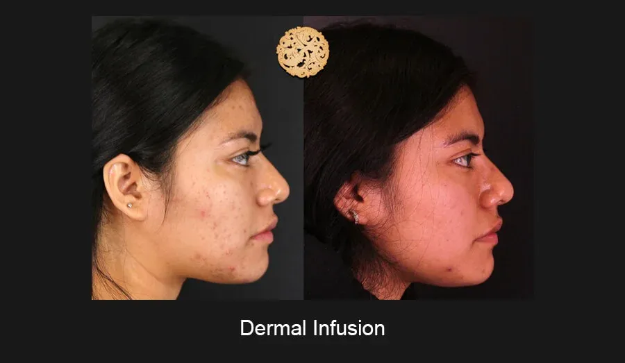 Dermal Infusion Before & After