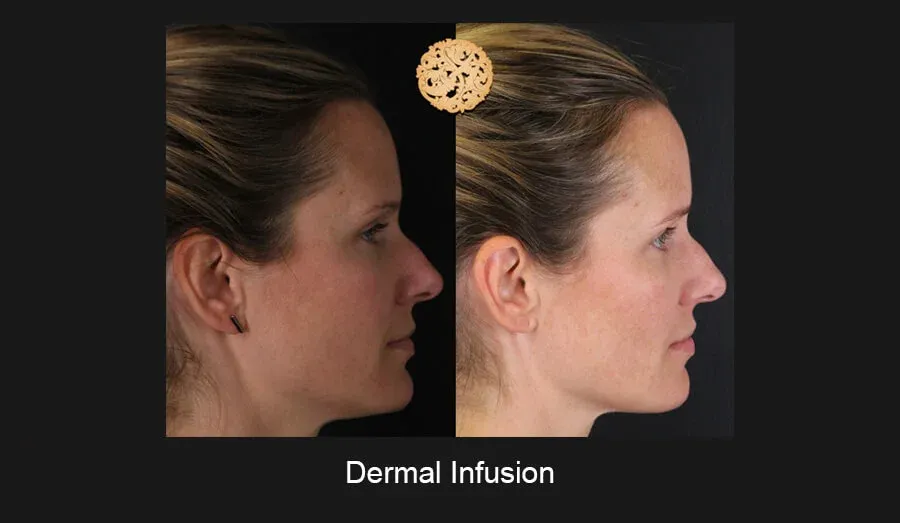 Dermal Infusion Before & After
