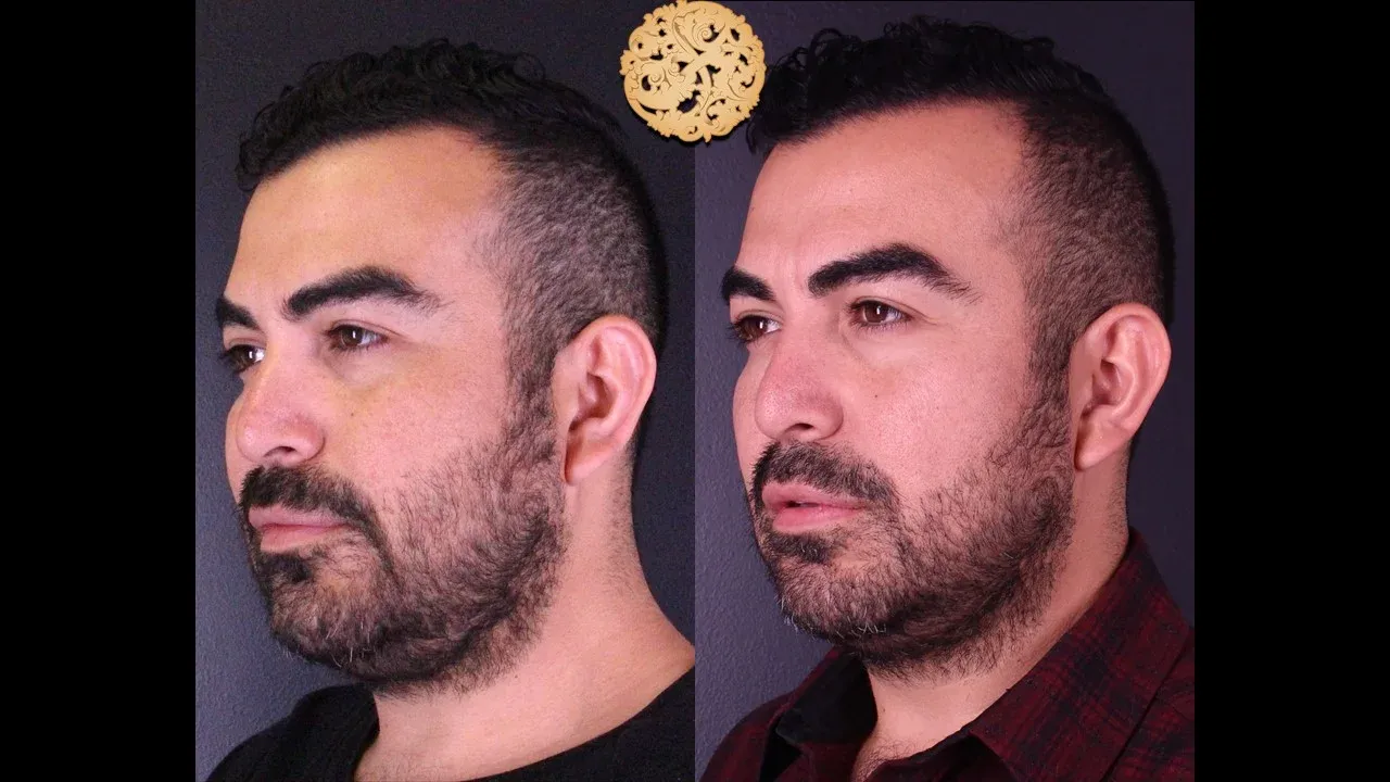 Dermal Infusion Before & After