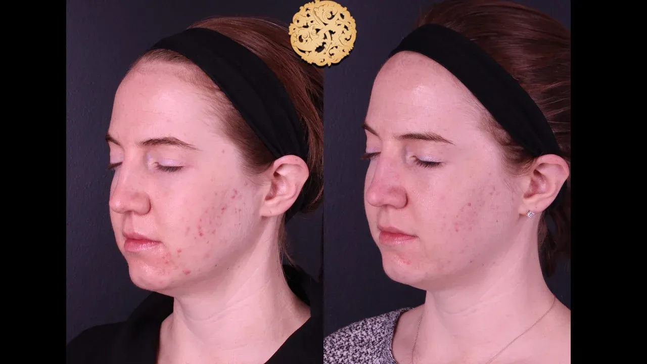 Dermal Infusion Before & After