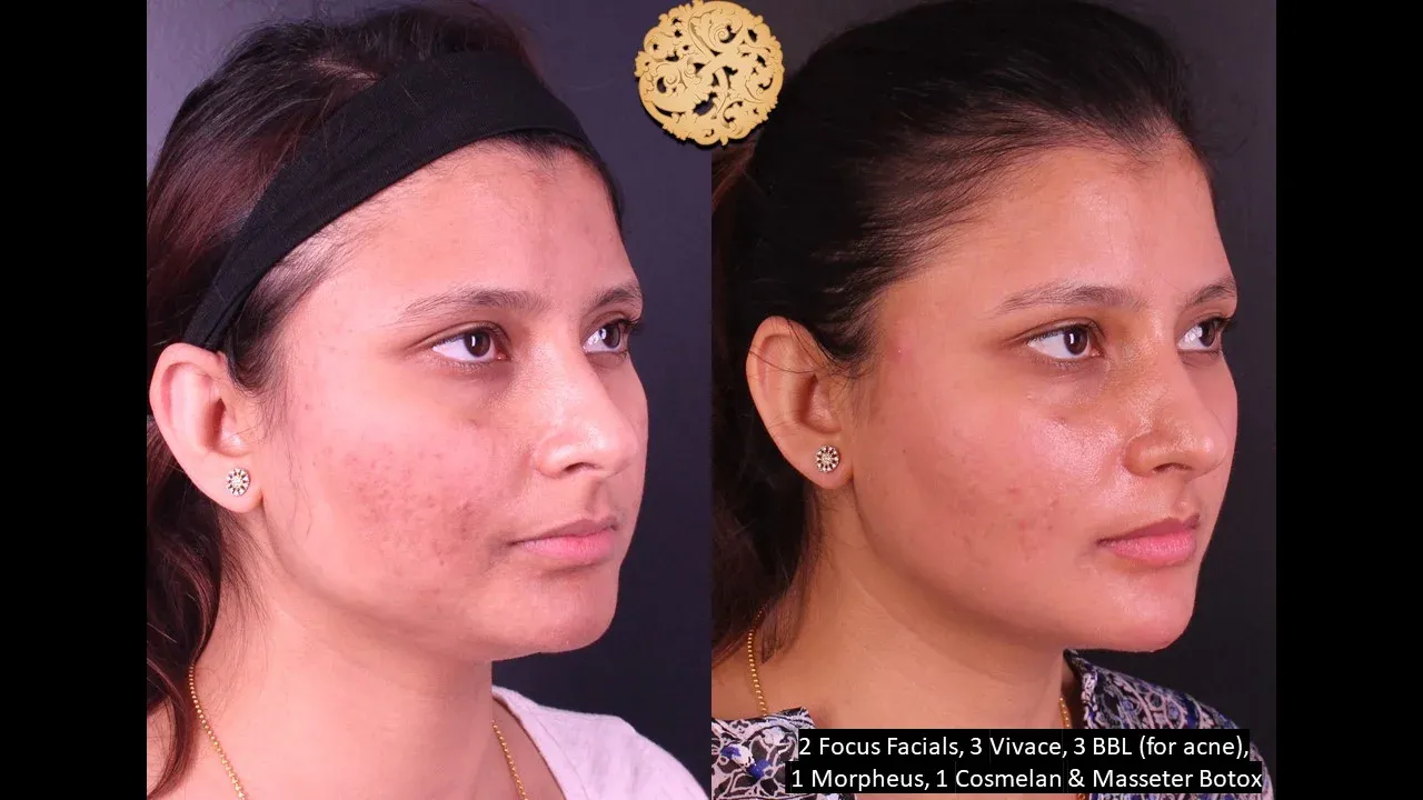 Dermal Infusion Before & After