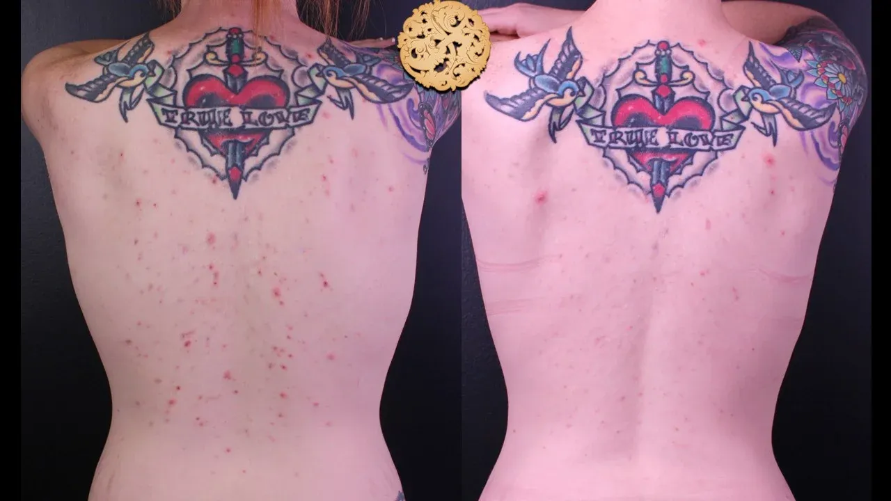 Dermal Infusion Before & After
