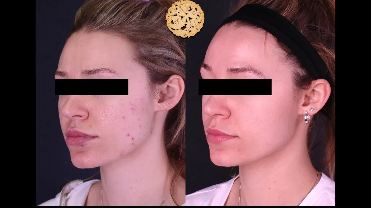 Dermal Infusion Before & After