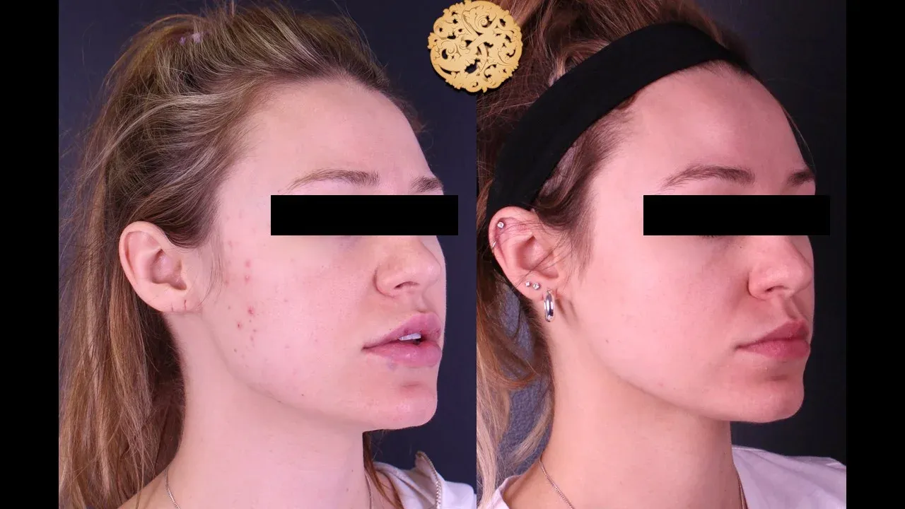 Dermal Infusion Before & After
