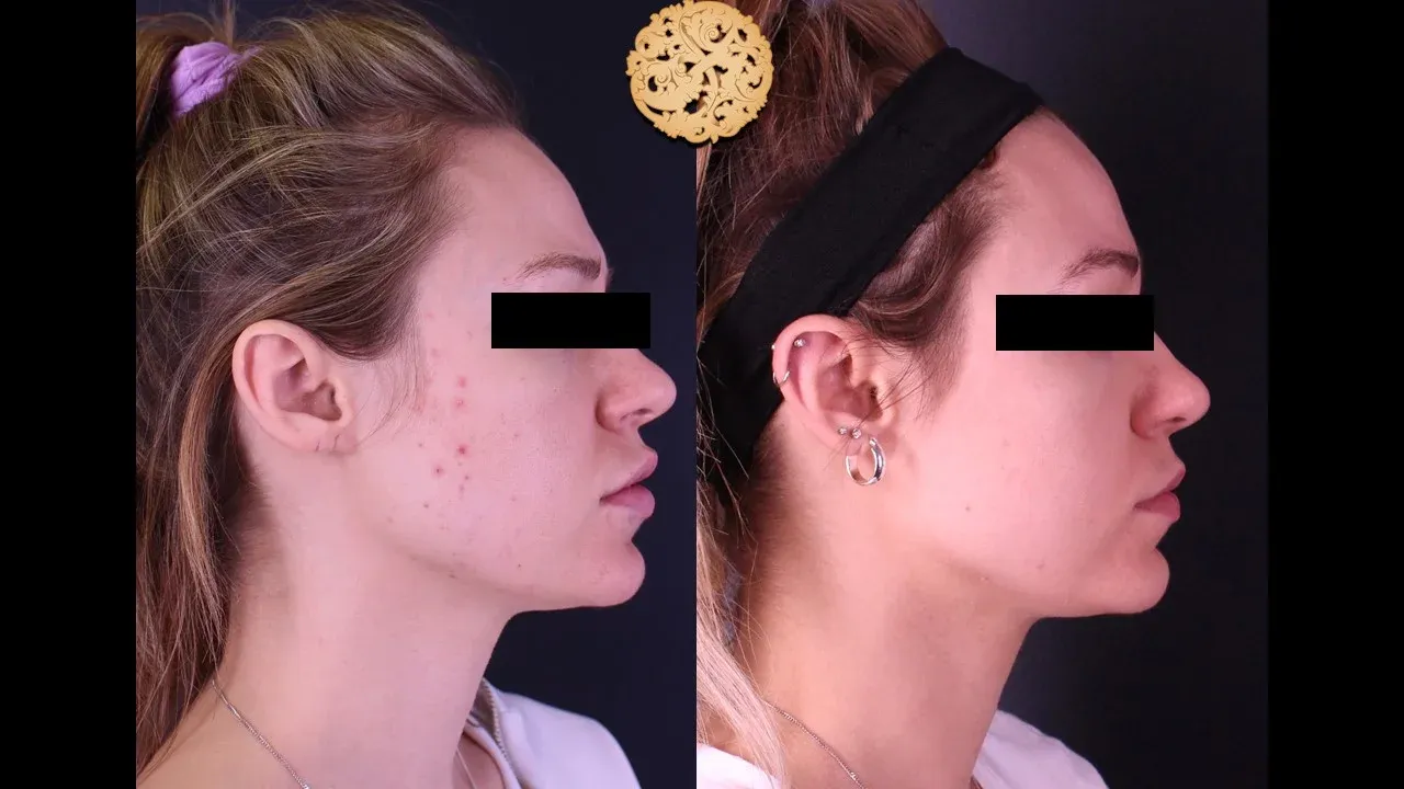 Dermal Infusion Before & After