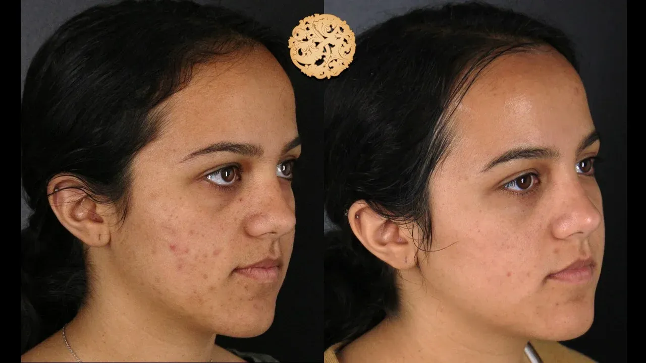Dermal Infusion Before & After