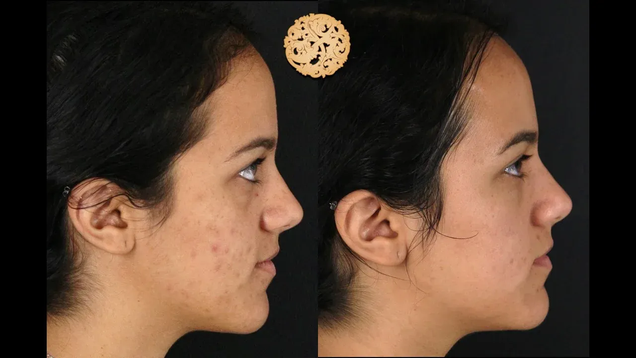 Dermal Infusion Before & After