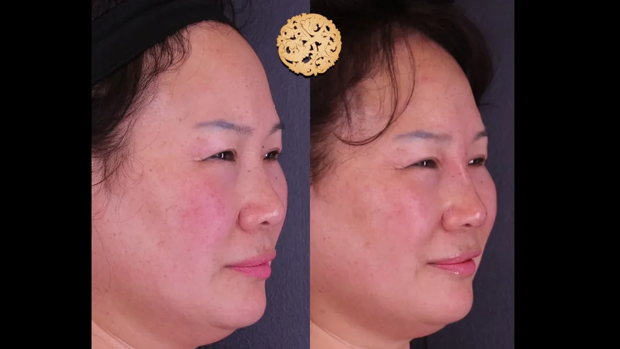 Dermal Infusion Before & After